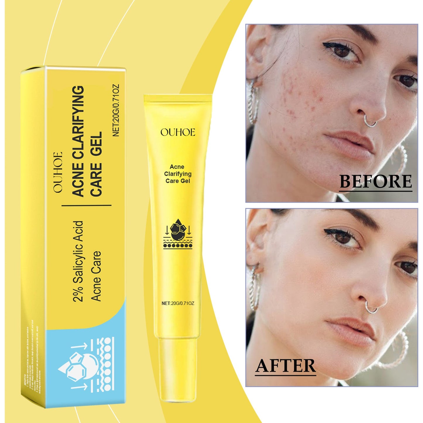 Acne-Clearing Gel, Deep Cleansing Facial Skin Brightening And Concealer Treatment Gel For Acne Reduction - Korvel