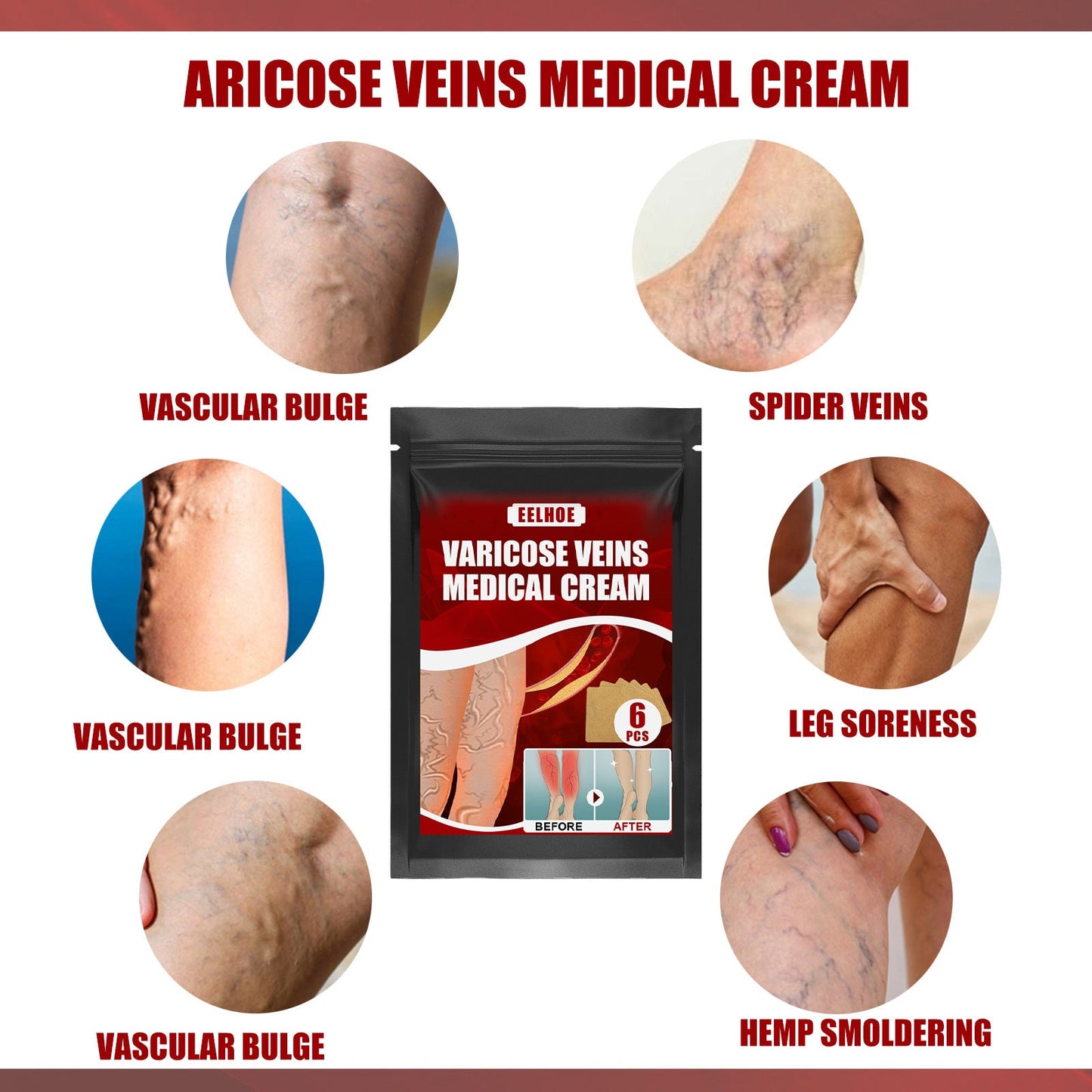 Aricose Veins Medical Cream, Relieve Leg Swelling Earthworm Leg Vein Massage To Relieve Pain - Korvel