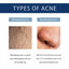Anti-Pimple Drying Lotion, Facial Cleansing And Repair Lighten Acne Marks And Pits, Close Your Mouth And Mild Skin Cream - Korvel