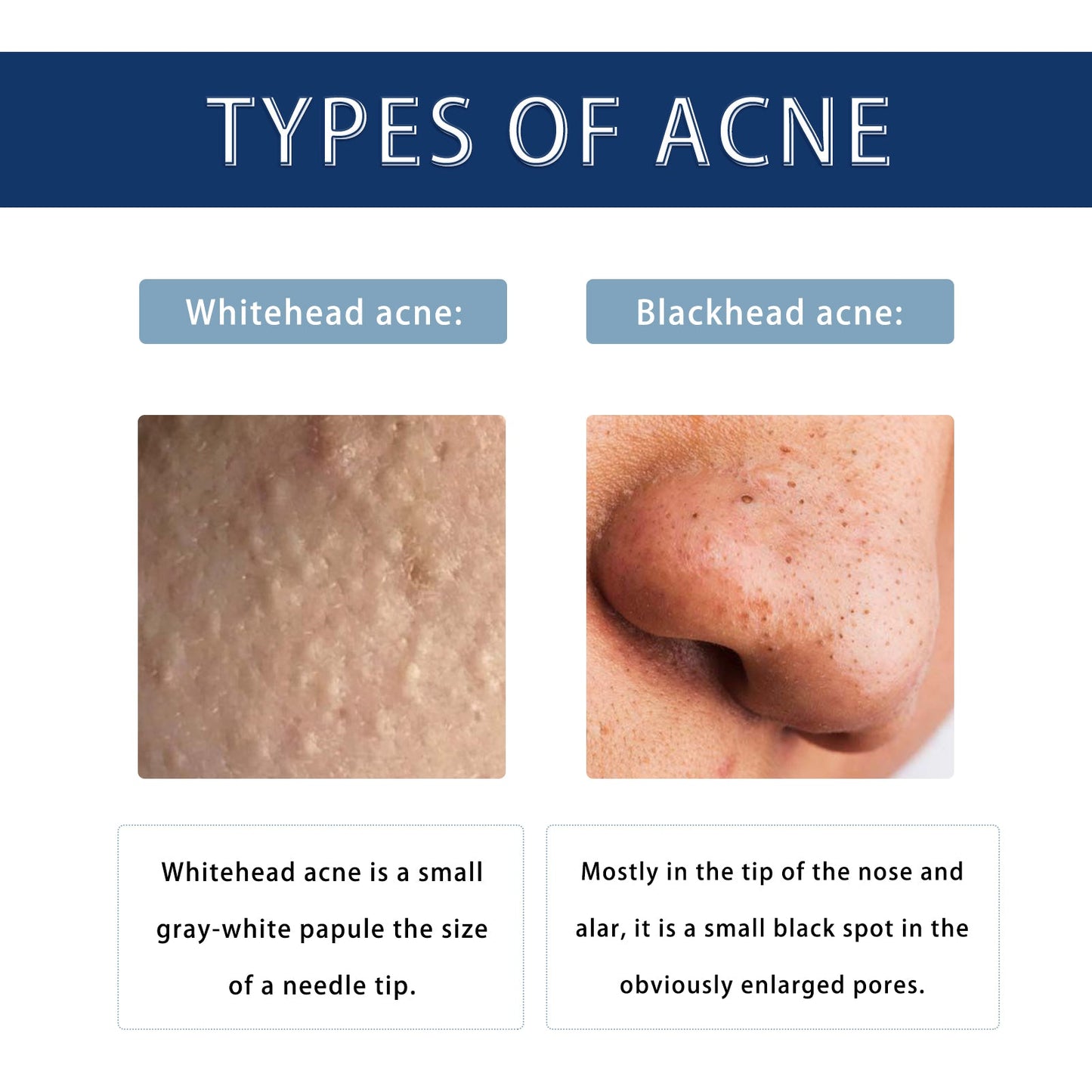 Anti-Pimple Drying Lotion, Facial Cleansing And Repair Lighten Acne Marks And Pits, Close Your Mouth And Mild Skin Cream - Korvel