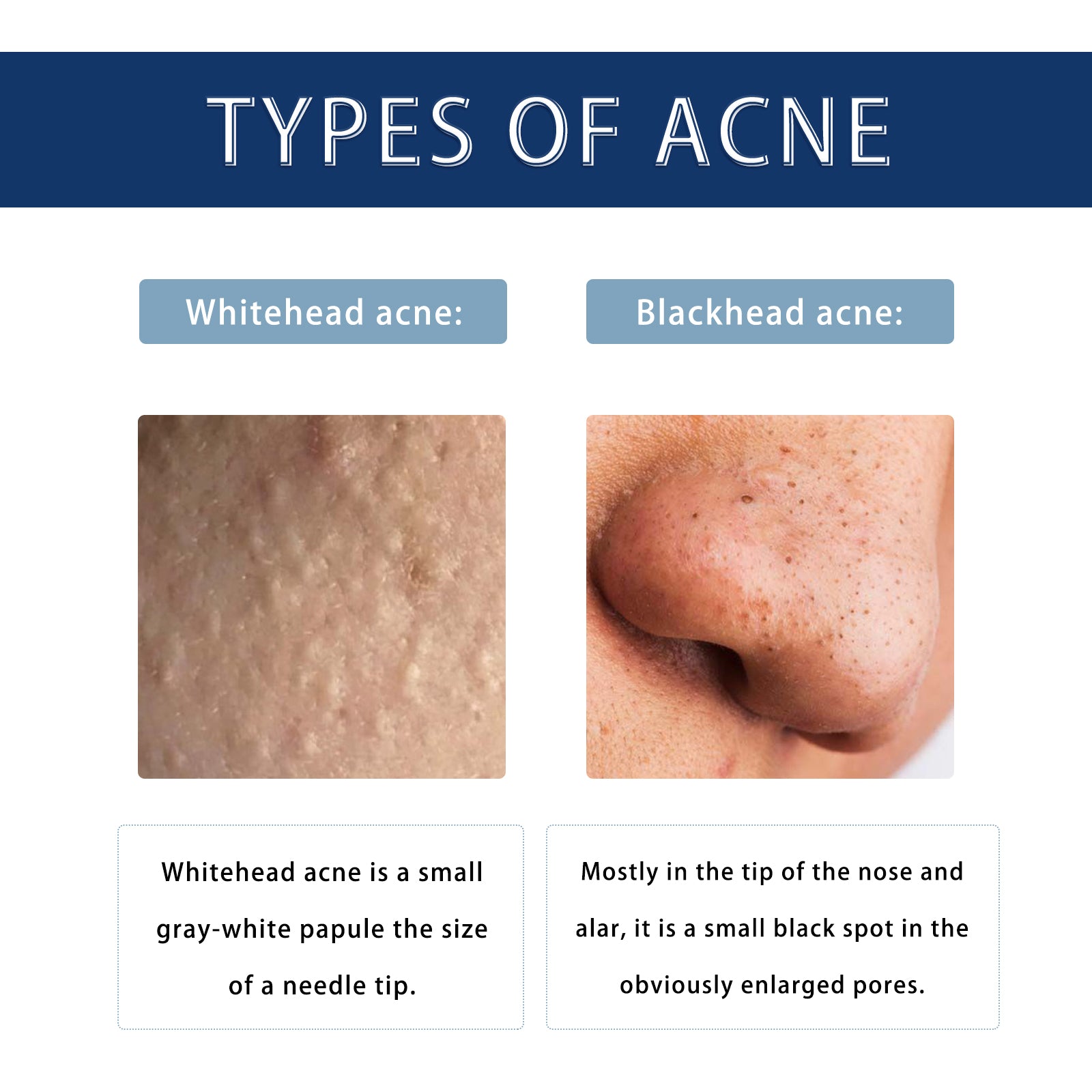 Anti-Pimple Drying Lotion, Facial Cleansing And Repair Lighten Acne Marks And Pits, Close Your Mouth And Mild Skin Cream - Korvel