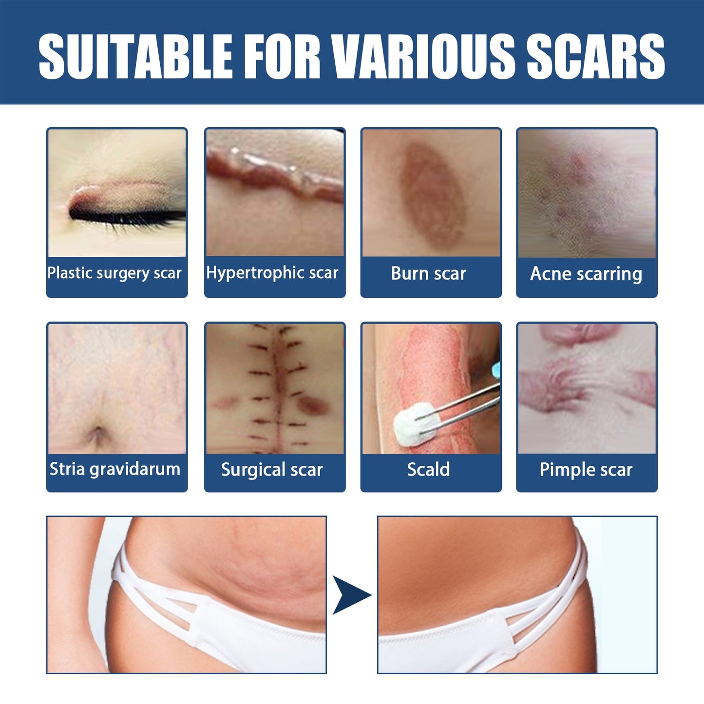 Scar Balm, Surgery Scar Repair Cold Compress Scar Skin Scar Gel Balm - Korvel