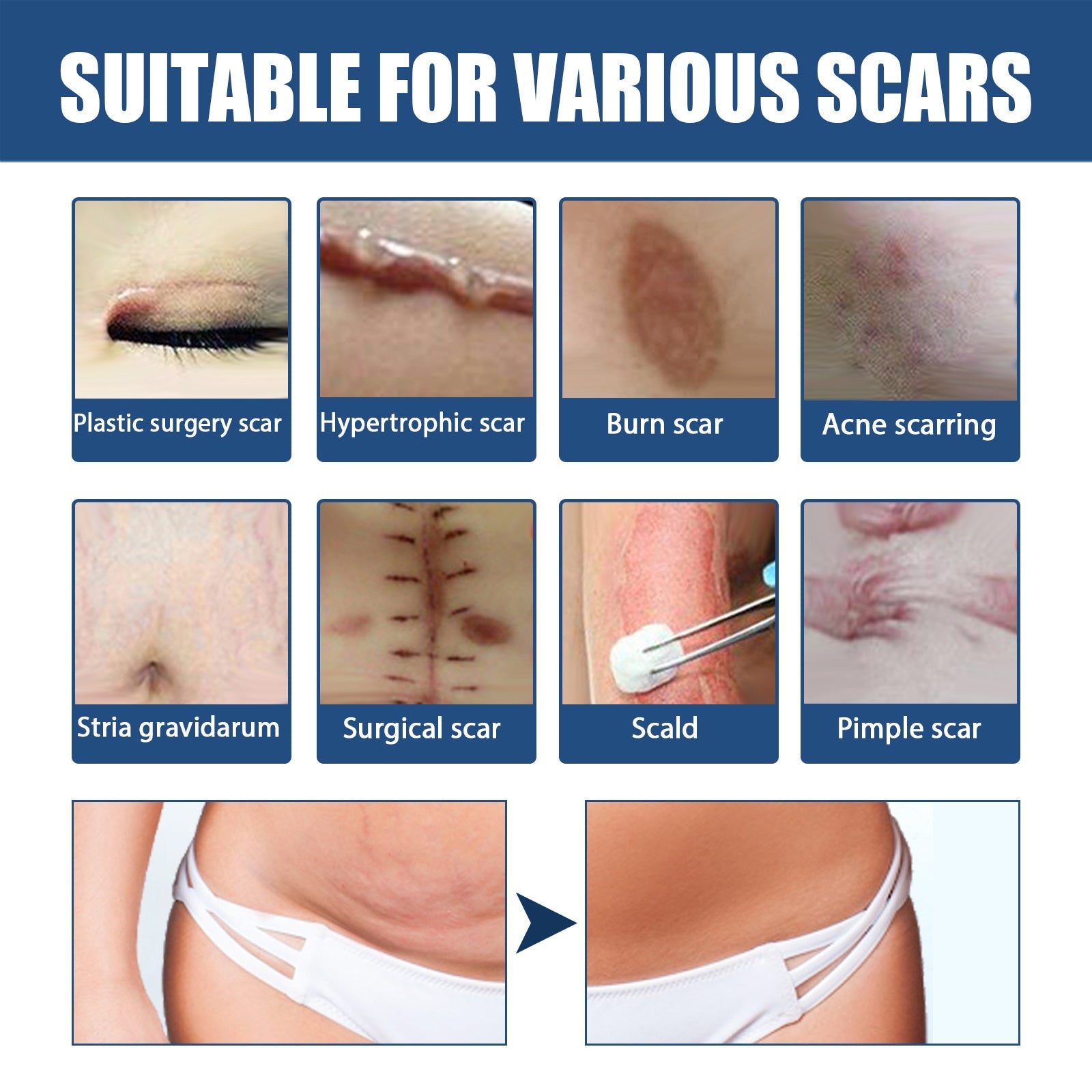 Scar Balm, Surgery Scar Repair Cold Compress Scar Skin Scar Gel Balm - Korvel