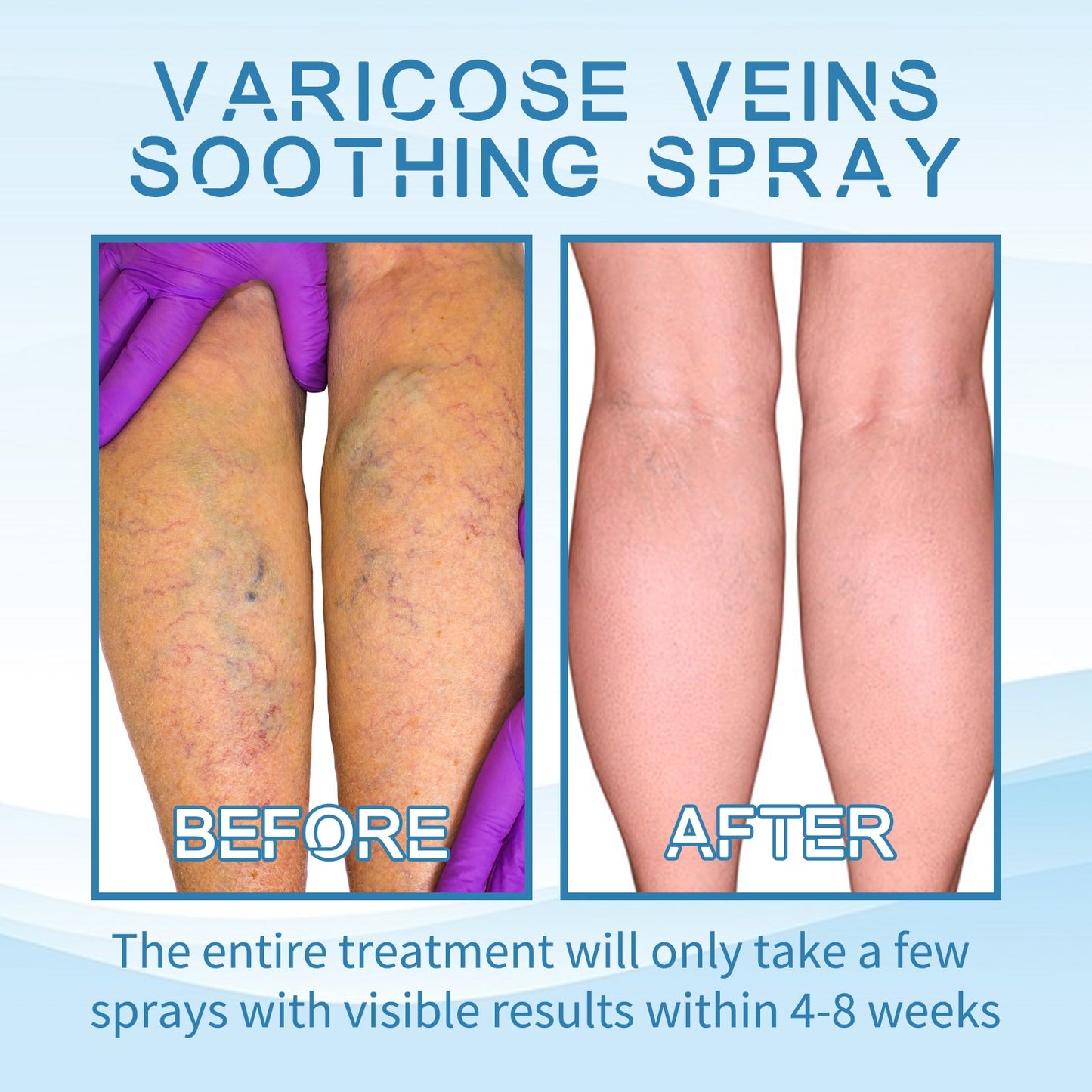Spray Premium para el Tratamiento de Venas en las Piernas para Comodidad y Cuidado