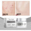 Refreshing Oil Control Acne Cream for Soothing Care