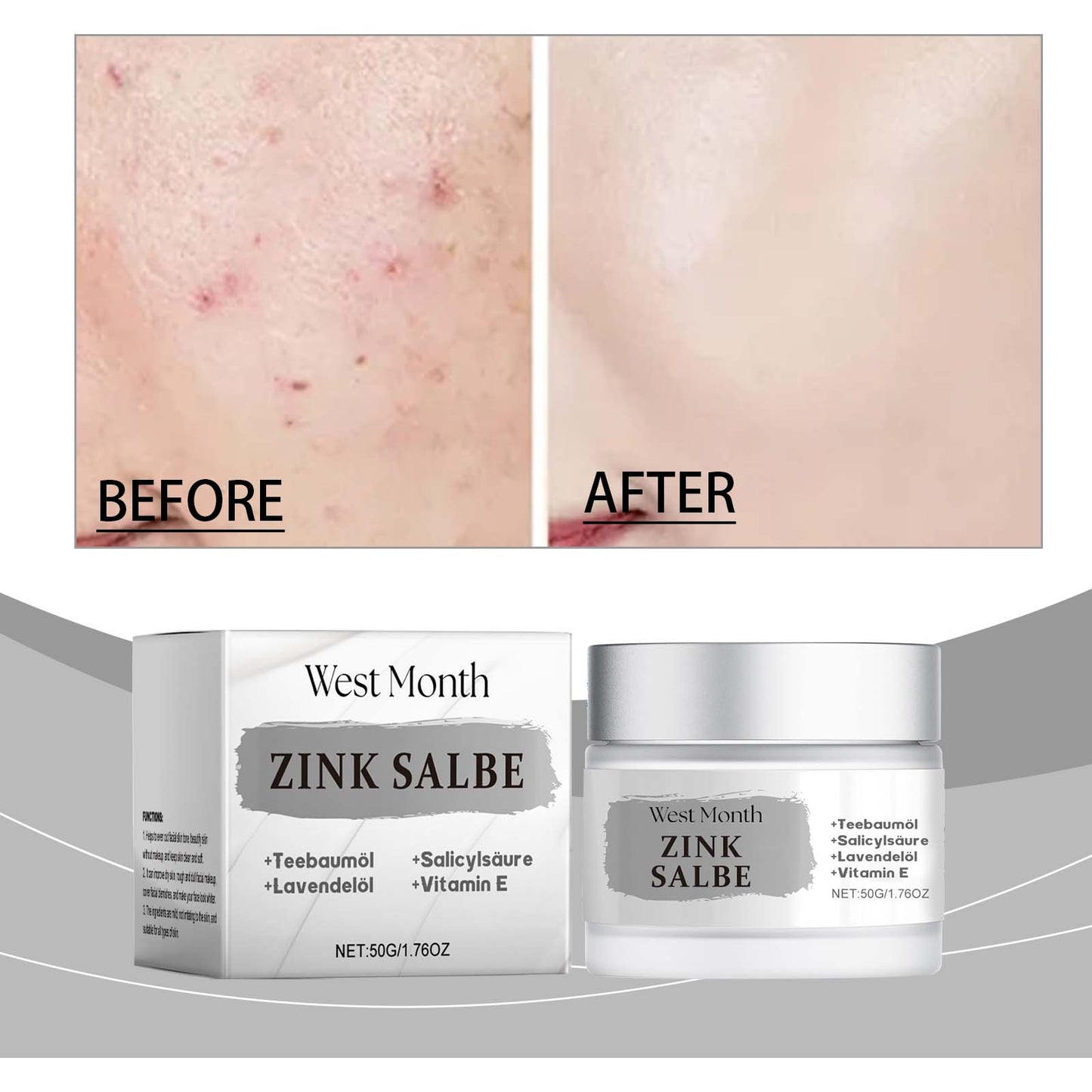 Refreshing Oil Control Acne Cream for Soothing Care
