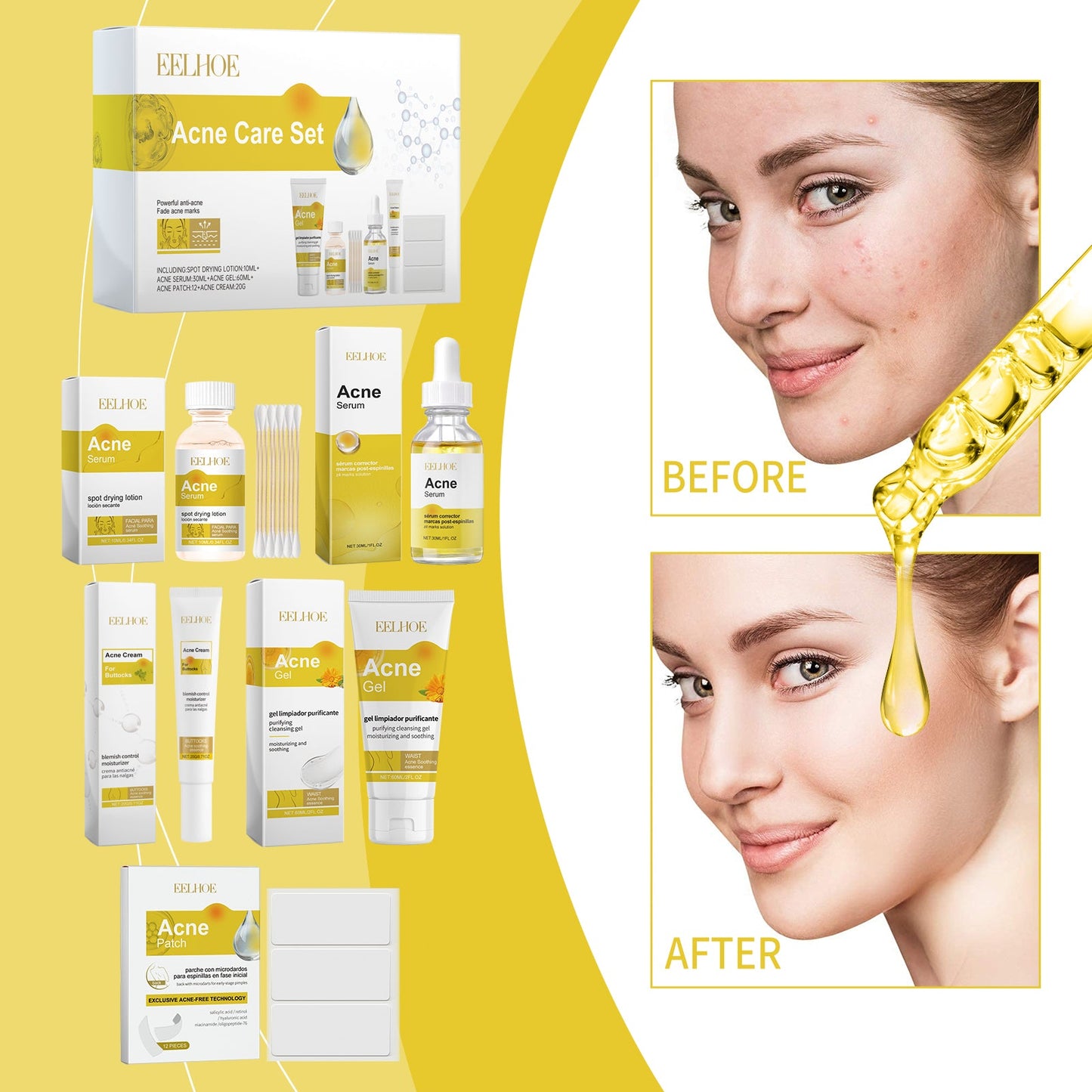 Acne Skin Care Set Skin Care For Acne Skin Is Suitable For Moisturizing And Beautify Soft Skin - Korvel