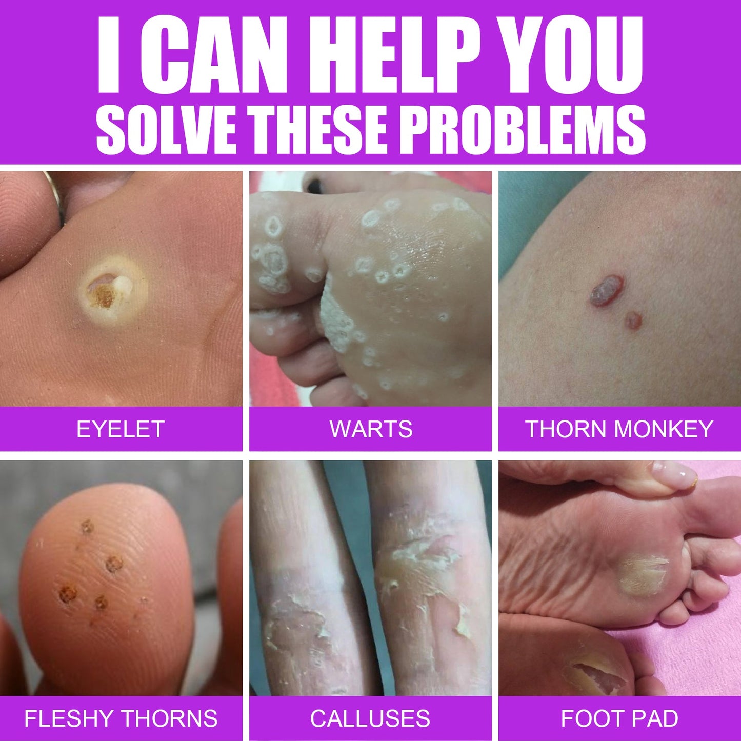 Remove Chicken Eye Lotion Extra Clear Remove Corns Skin Care Chicken Calluses Foot Pad Gram Warts - Korvel