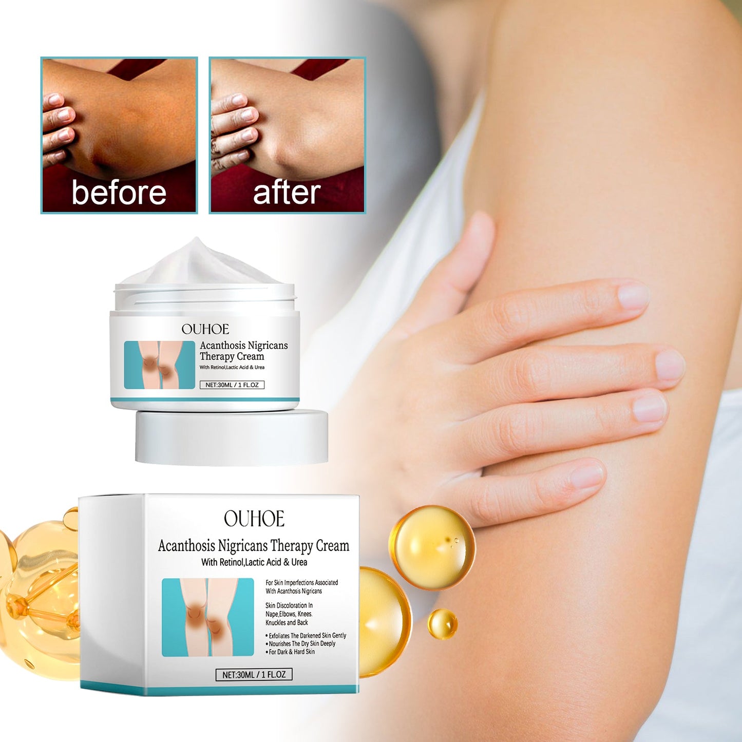 Acanthosis Nigricans Therapy Cream, Repair Dull Skin Lightening Joint Black Moisturizing Whitening Skin Care Cream - Korvel