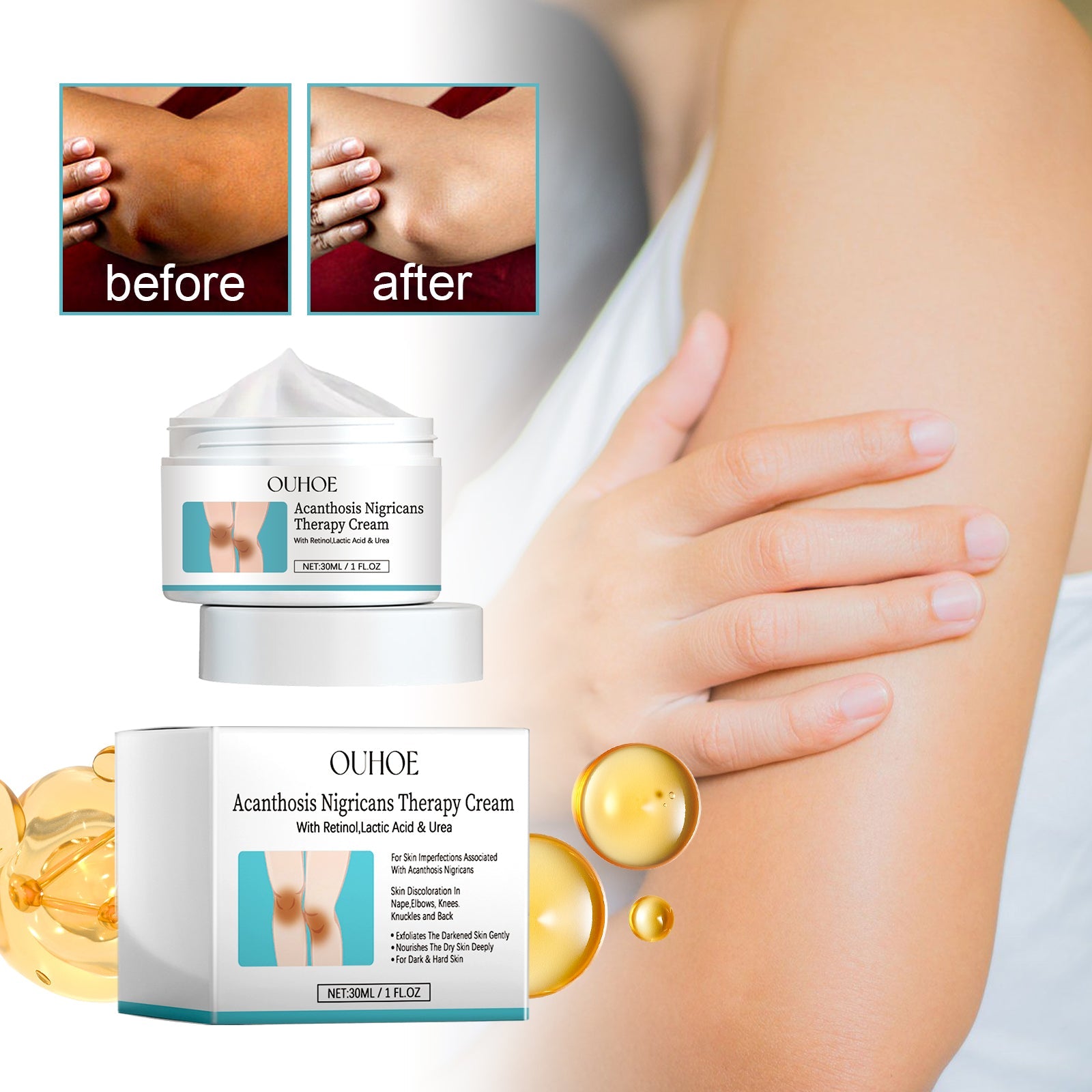Acanthosis Nigricans Therapy Cream, Repair Dull Skin Lightening Joint Black Moisturizing Whitening Skin Care Cream - Korvel