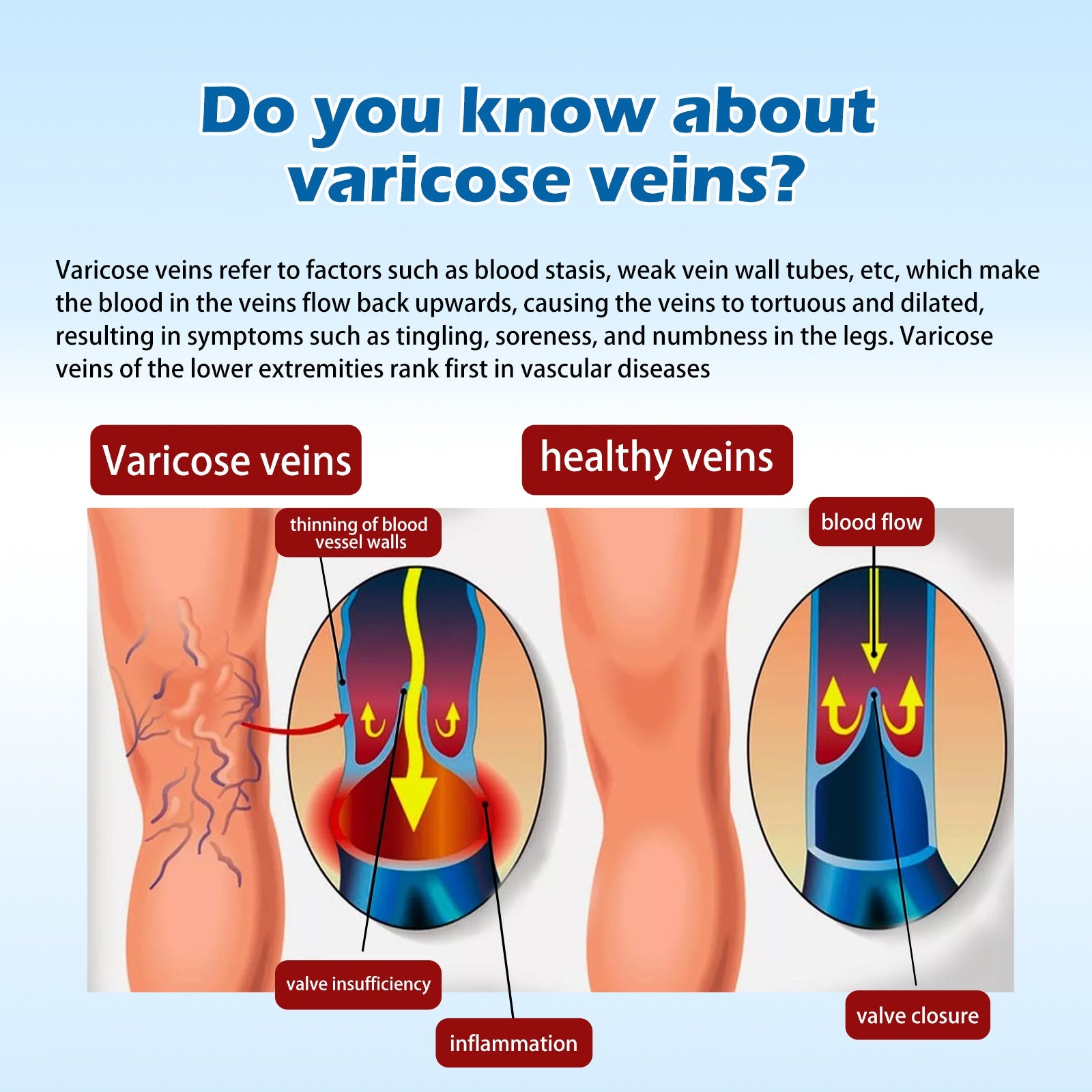 Varicose Vein Slimming Cream, Vein Repair Body Care Reduces Leg Muscle Swelling Earthworm Leg Slimming Cream - Korvel