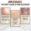 Lactose Solution, Exfoliate Remove Blackheads Shrink Pores Clean And Moisturize SkinEssence - Korvel