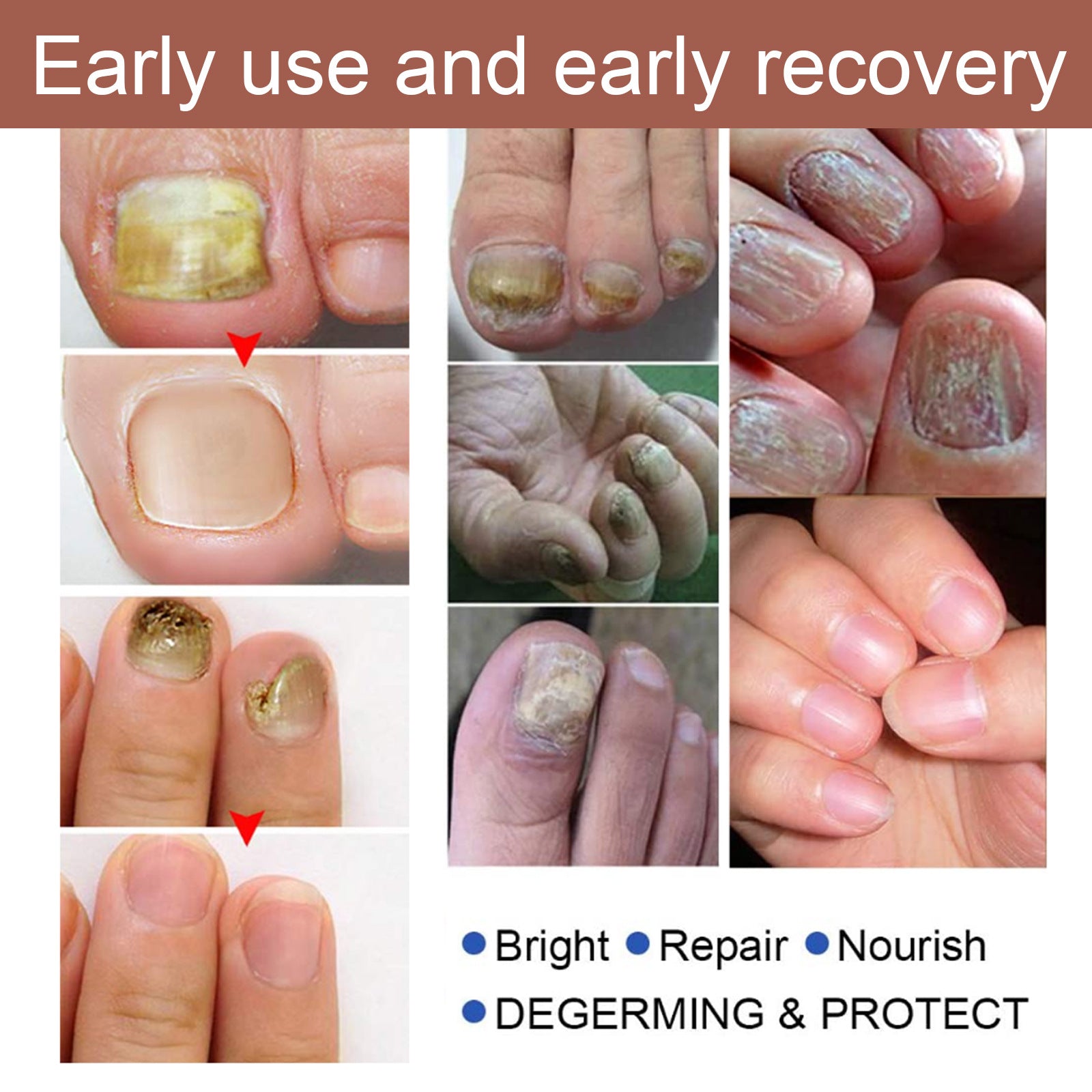 Herbal Antibacterial Nail Treatments Essential Oil, Grey Nail Care Essential Oil Brightening Nail Polish Clean Manicure Foot Care Solution - Korvel