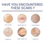 Scar Gel, Fade Skin Scar Pregnancy Surgery Scar Moisturizing Skin Care Gel - Korvel