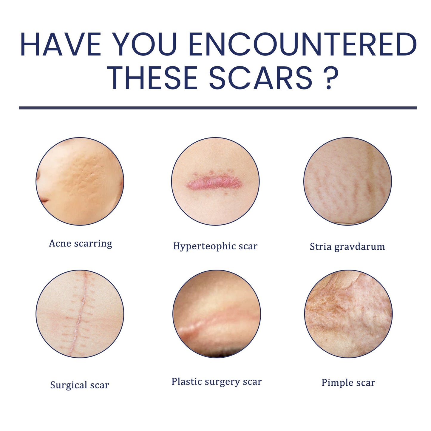 Scar Gel, Fade Skin Scar Pregnancy Surgery Scar Moisturizing Skin Care Gel - Korvel