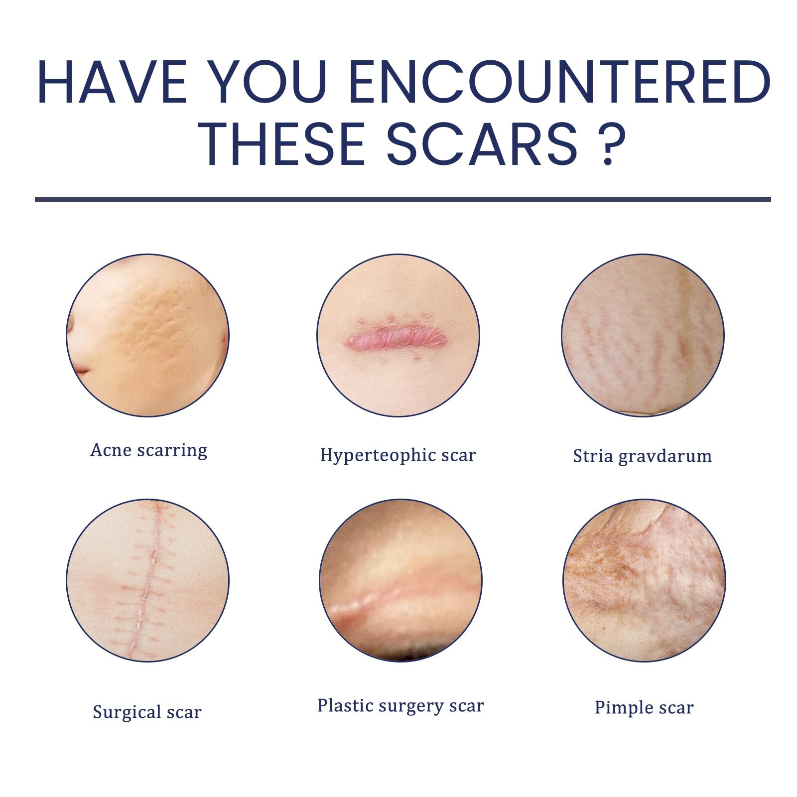 Scar Gel, Fade Skin Scar Pregnancy Surgery Scar Moisturizing Skin Care Gel - Korvel