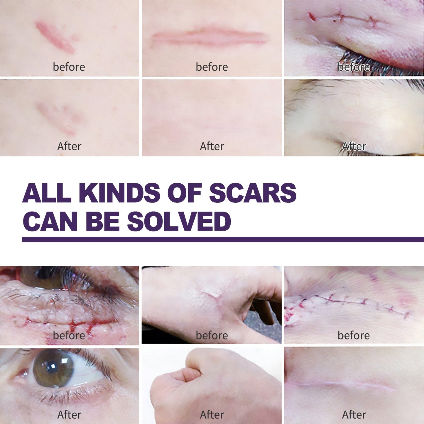 Silicone Scar Patch, Reduces Stretch Marks And Hyperplasia Of Caesarean Section Scars Silicone Patch - Korvel