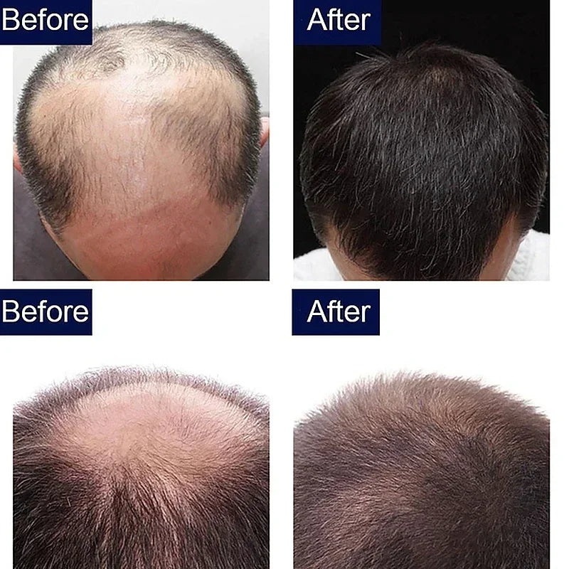 7 Day Fast Hair Growth Oil Ginger Growth Hair Treatment Anti Hair Loss Men Women Scalp Treatment Serum Products Beauty Product - Korvel