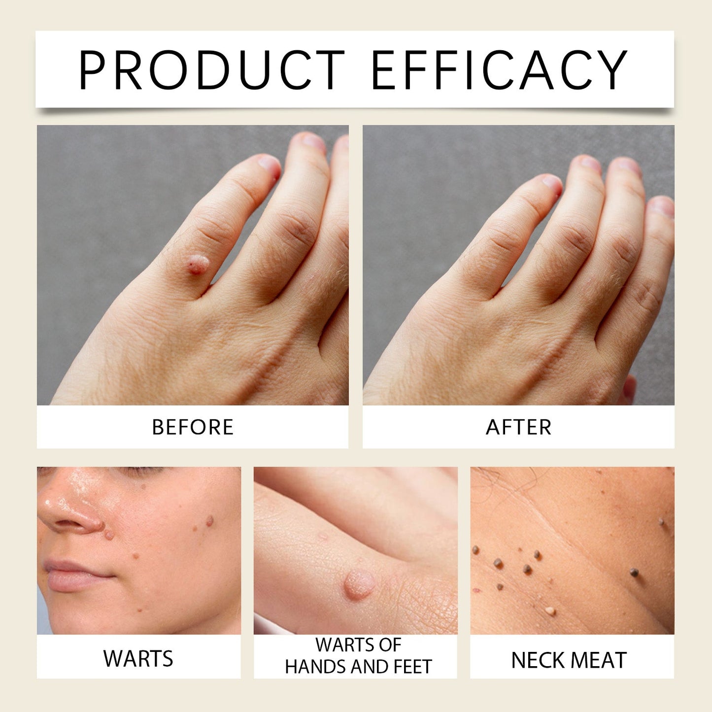 Mole And Wart Care Cream, Soft And Smooth Skin Moisturizing And Repairing Skin Care Cream - Korvel