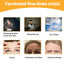 Forehead Wrinkle Patch, Lifts Lightens And Smooths Forehead Wrinkles Facial Skin Forehead Patch - Korvel