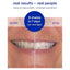 Supersmile Superstrips Teeth Whitening Dissolving Strips - 14 Count