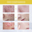 Orchid Acne Essential Oil Cleans And Brightens Pores And Hydrates Facial Care Essence - Korvel