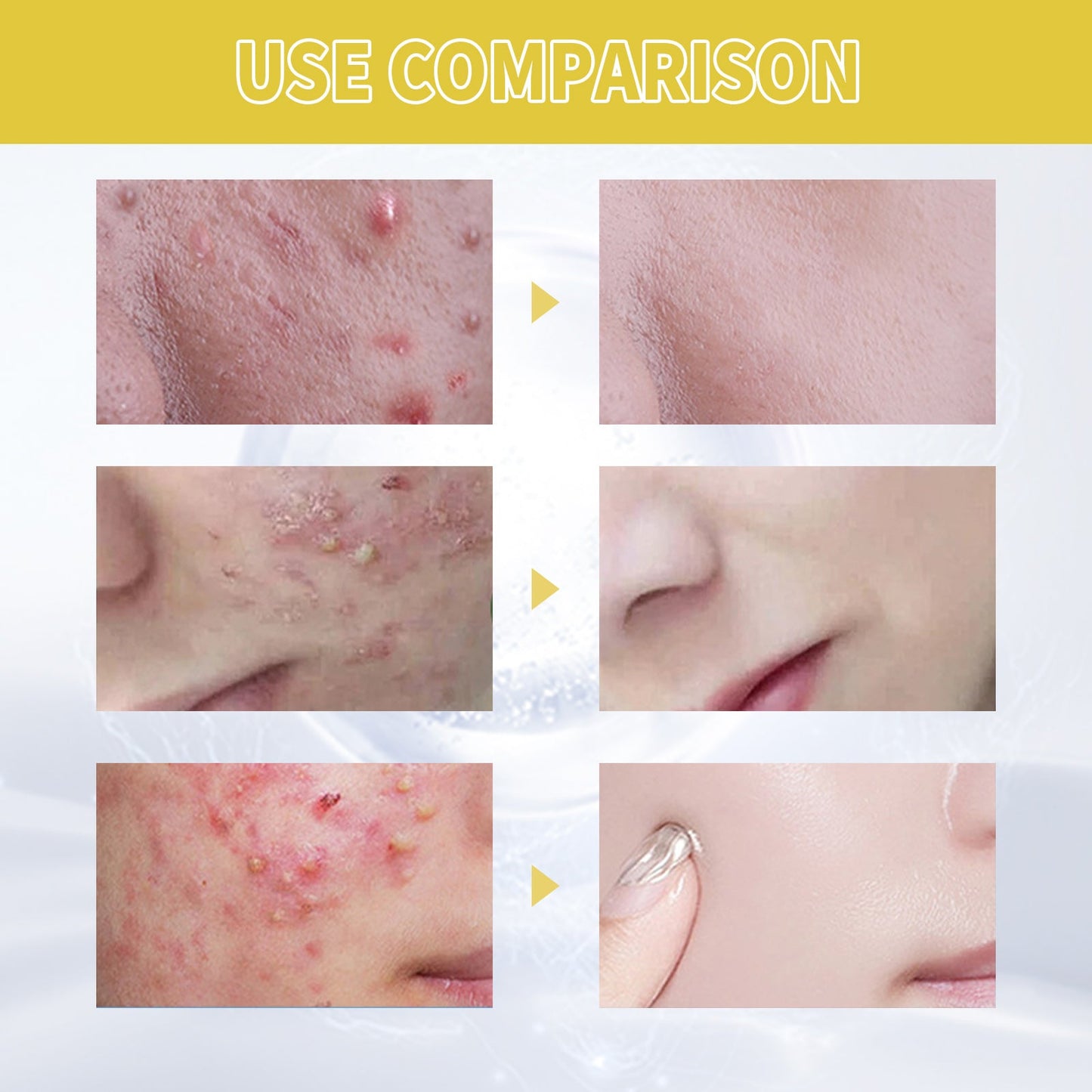 Orchid Acne Essential Oil Cleans And Brightens Pores And Hydrates Facial Care Essence - Korvel