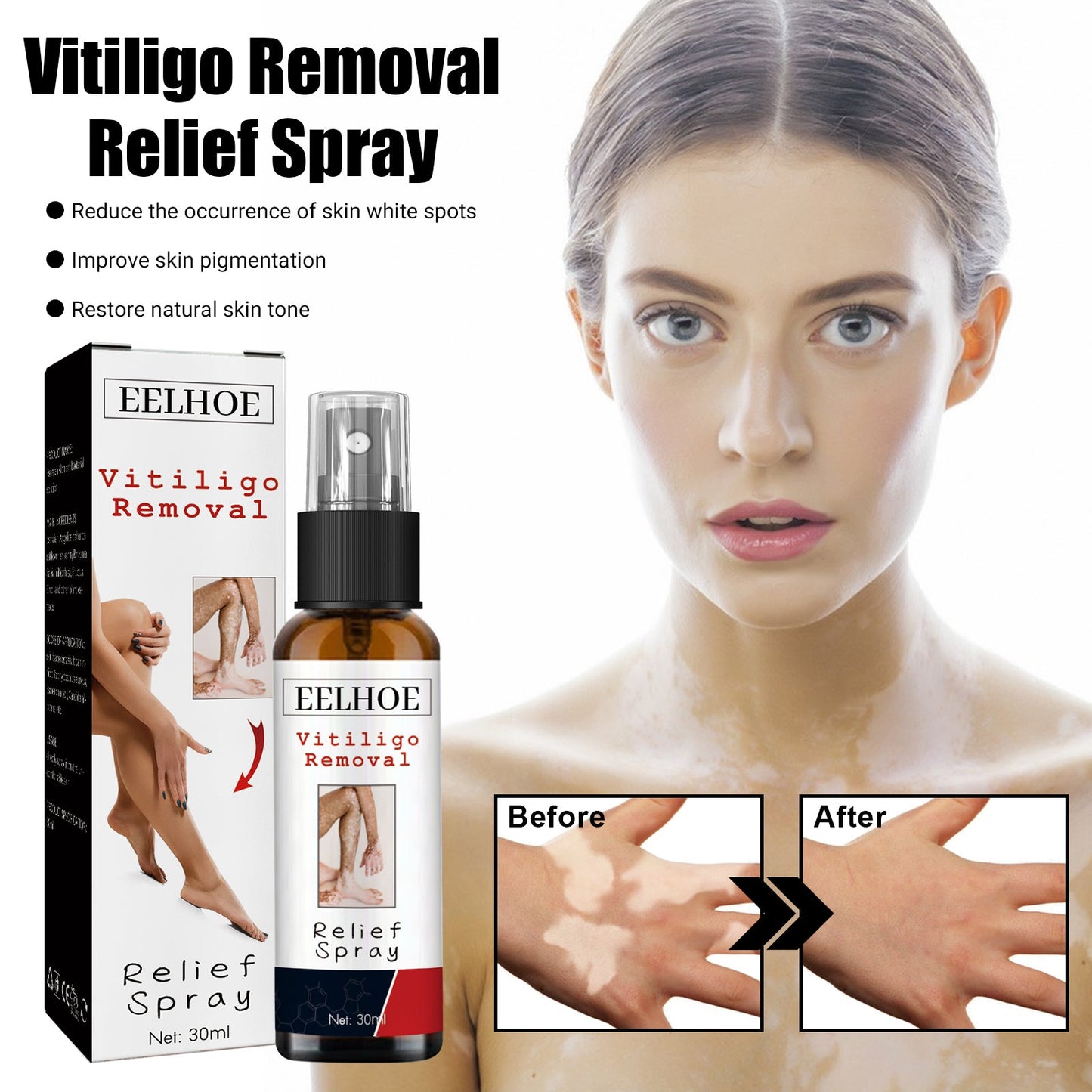 Vitiligo Removal Relief Spray, Repair Whitening Spot Perspiration Beauty Moisturizing Skin Care spray - Korvel