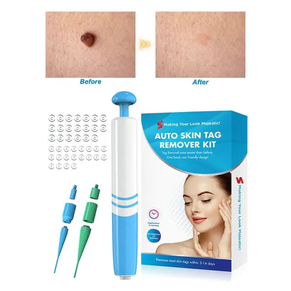 Gentle Skin Tag Removal Kit