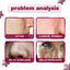 Acid Essence, Shrinks Pores, Removes Blackheads, Pimples And Acne Marks, Brightens Skin Tone Moisturizing Essence - Korvel