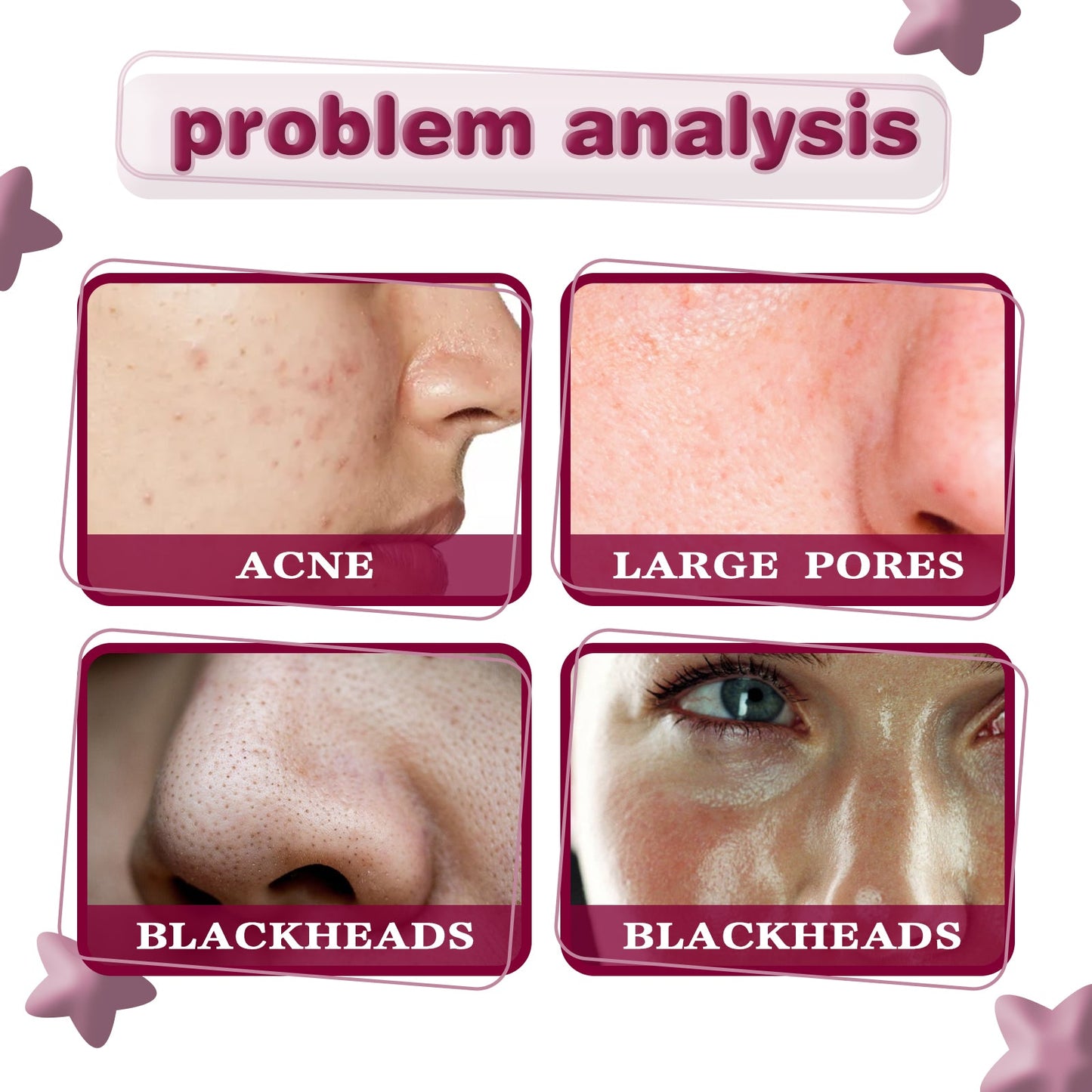 Acid Essence, Shrinks Pores, Removes Blackheads, Pimples And Acne Marks, Brightens Skin Tone Moisturizing Essence - Korvel