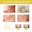 Orchid Acne Essential Oil Cleans And Brightens Pores And Hydrates Facial Care Essence - Korvel