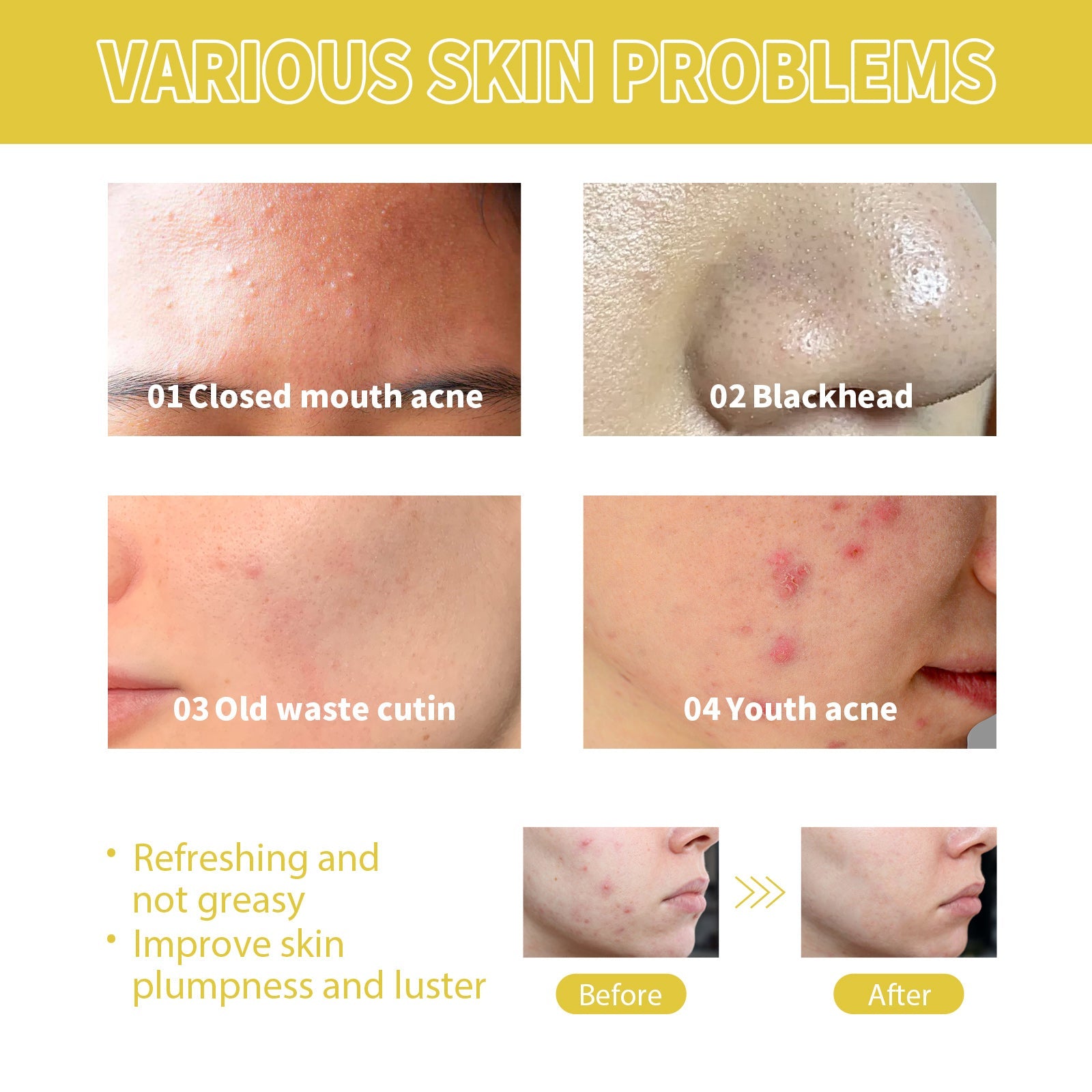 Orchid Acne Essential Oil Cleans And Brightens Pores And Hydrates Facial Care Essence - Korvel