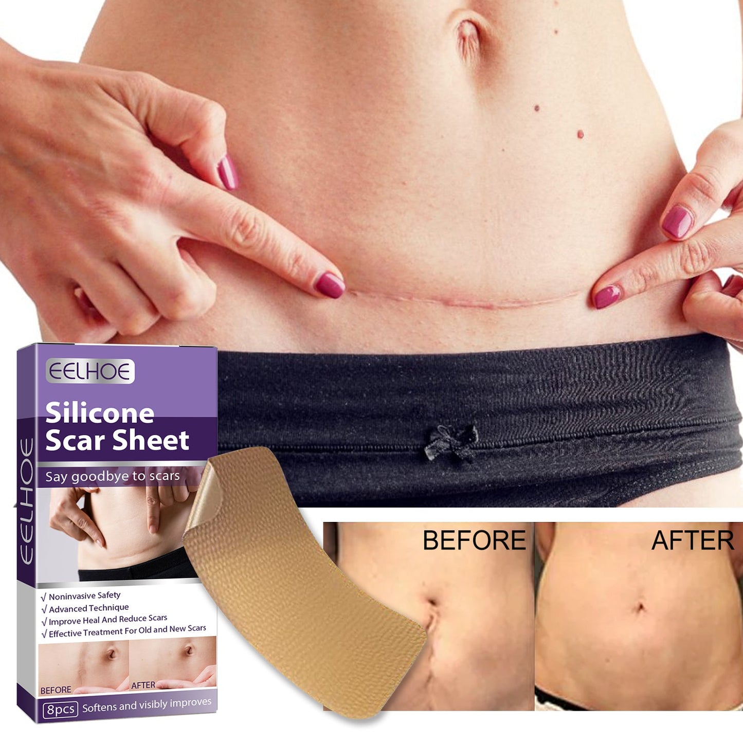 Silicone Scar Patch, Reduces Stretch Marks And Hyperplasia Of Caesarean Section Scars Silicone Patch - Korvel