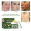 Herbal Acne-Removing Cream Anti-acne-Removing Cream Moisturizing Cleansing Cream Water Oil Balance Anti-acne-Removing Cream - Korvel