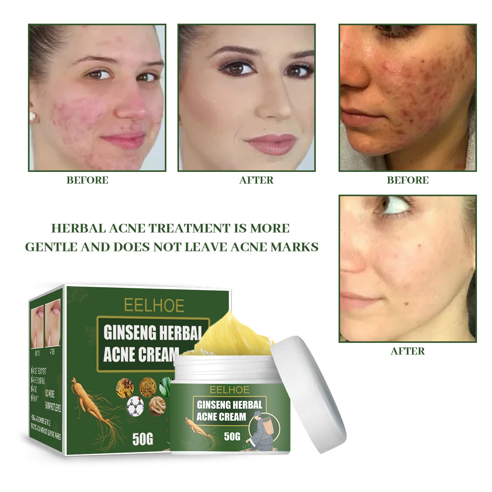 Herbal Acne-Removing Cream Anti-acne-Removing Cream Moisturizing Cleansing Cream Water Oil Balance Anti-acne-Removing Cream - Korvel
