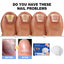Pure Nail Phototherapy Device, Repair Broken Nails Innail Thickening Brightening Nails Gentle Cleaning Gray Nail Care - Korvel