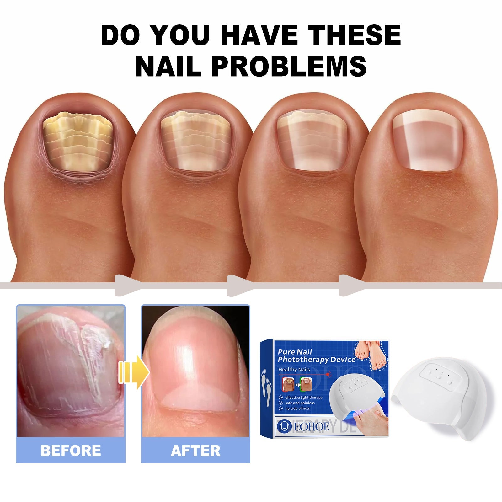 Pure Nail Phototherapy Device, Repair Broken Nails Innail Thickening Brightening Nails Gentle Cleaning Gray Nail Care - Korvel