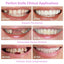 Simulation braces smile whitening sixth generation non-porous teeth set dentures - Korvel