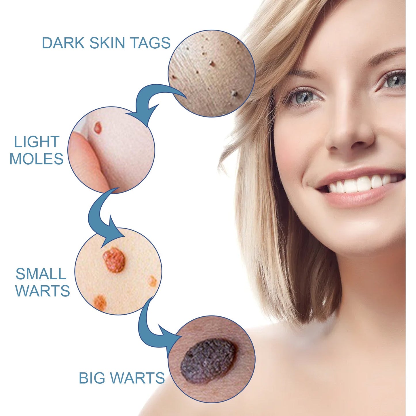 Crème Premium pour Verrues pour un Soin de la Peau Lisse