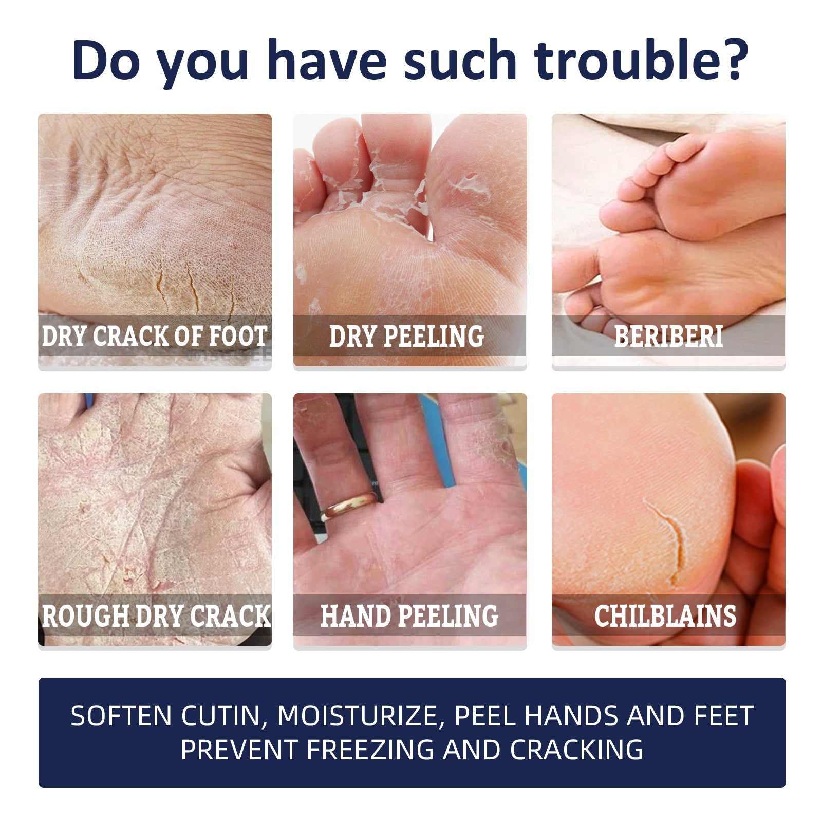 Anti-Crack Repair Hand Cream, Improves Cracked Rough Skin, Removes Dead Skin And Hydrates Hands And Feet Cream - Korvel