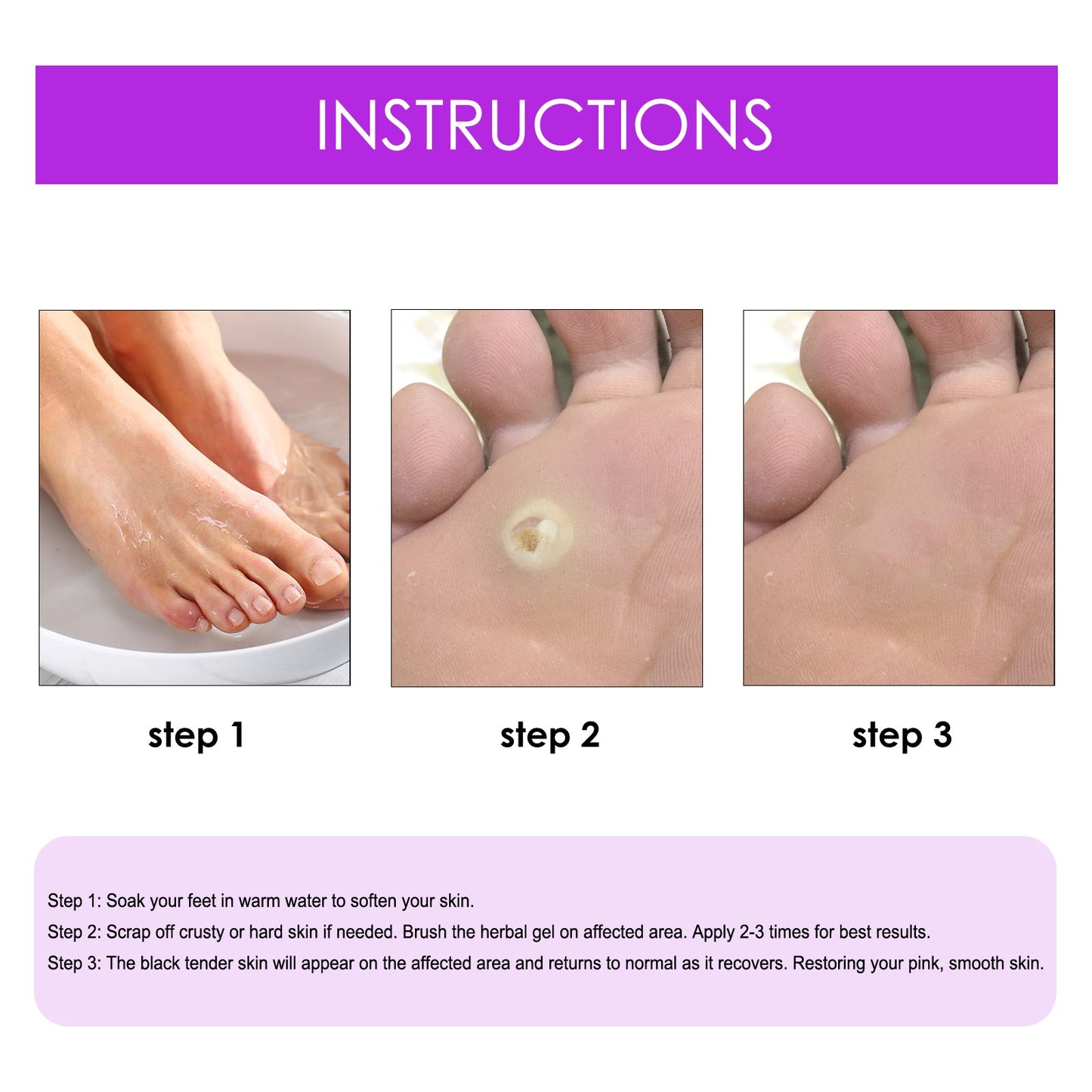 Remove Chicken Eye Lotion Extra Clear Remove Corns Skin Care Chicken Calluses Foot Pad Gram Warts - Korvel
