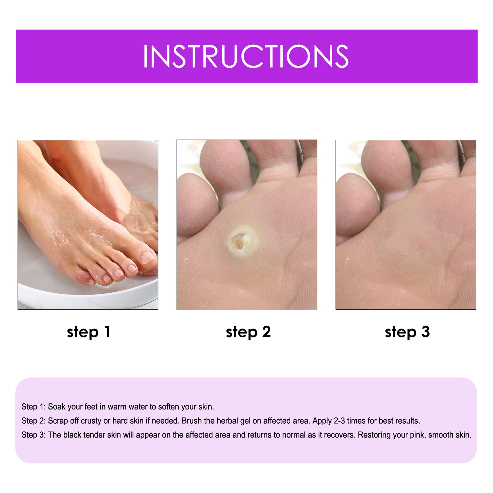 Remove Chicken Eye Lotion Extra Clear Remove Corns Skin Care Chicken Calluses Foot Pad Gram Warts - Korvel