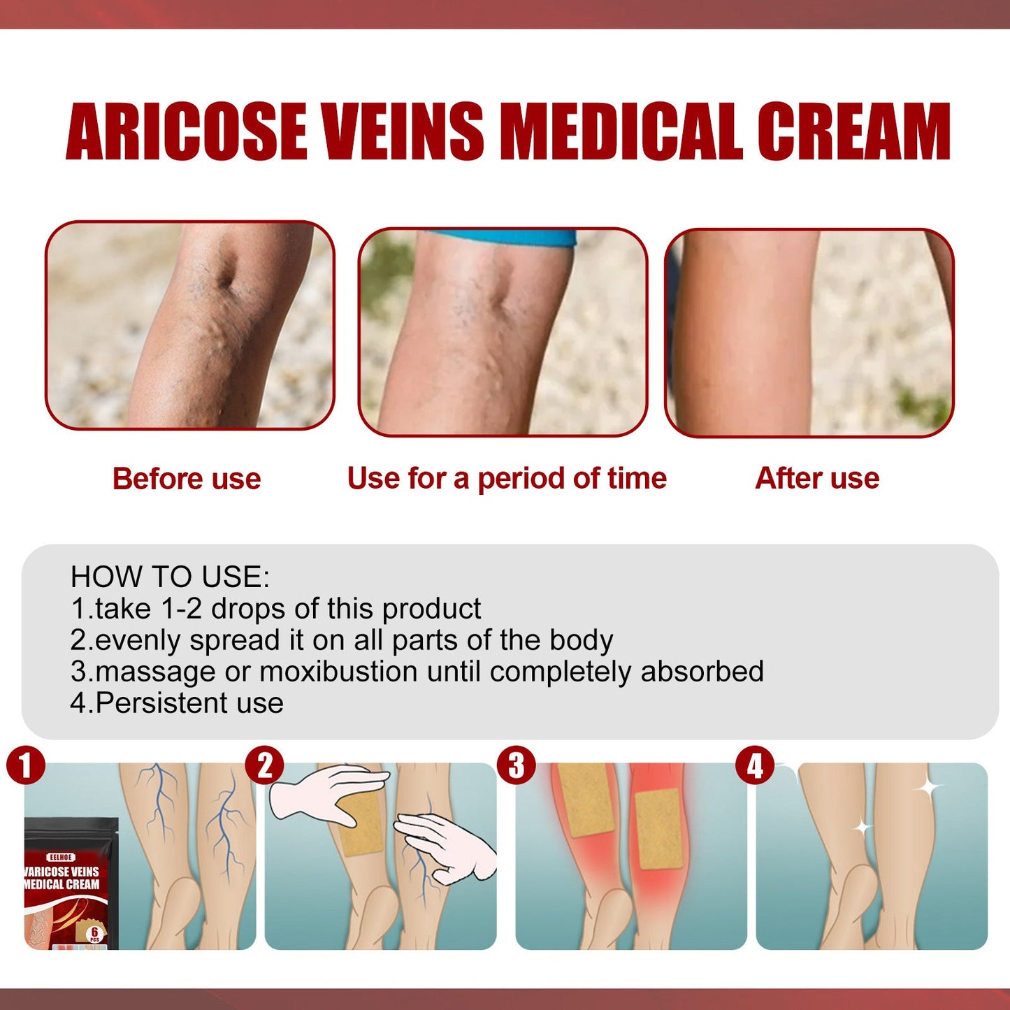 Aricose Veins Medical Cream, Relieve Leg Swelling Earthworm Leg Vein Massage To Relieve Pain - Korvel