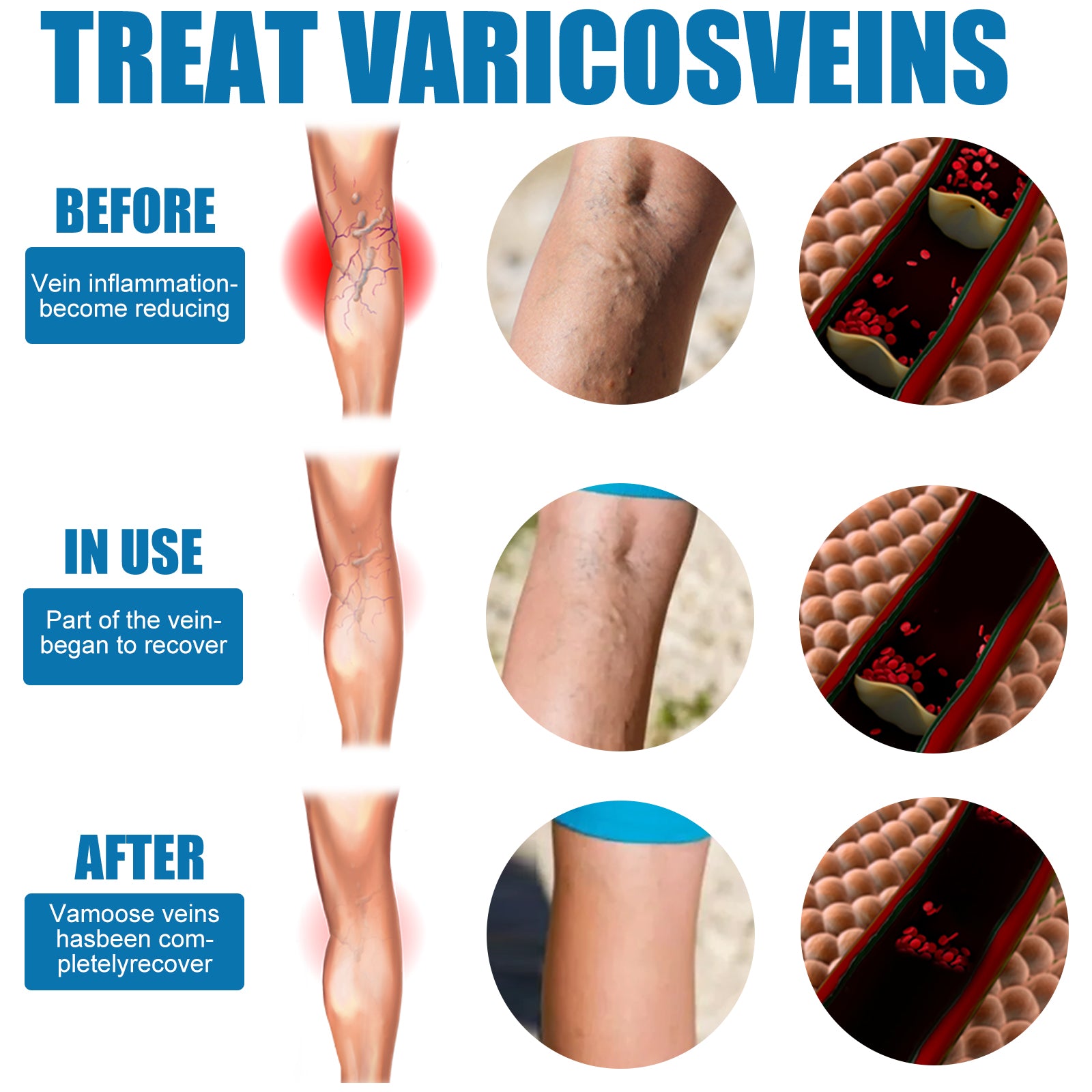Leg Care Spray Gently Relieve Leg Discomfort, Blue Veins And Bumps Repair Daily Care - Korvel