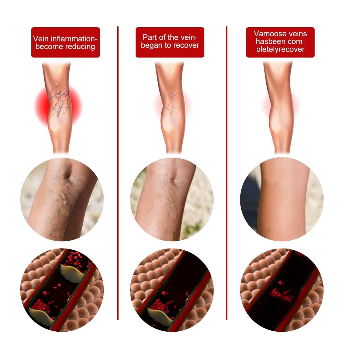 Intravenous Massage Spray For Varicose Veins Relief And Earthworm Leg Blood Vessel Bulge Pain Spray - Korvel