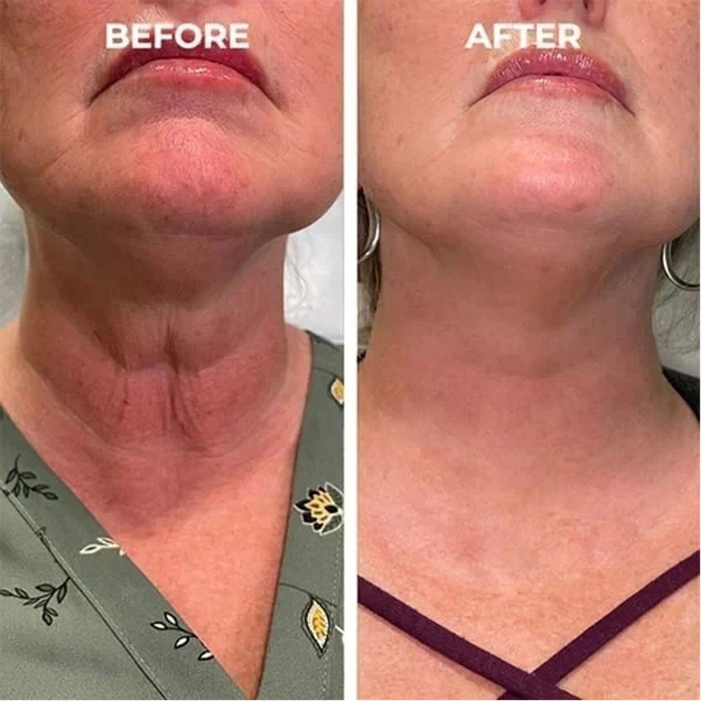 Facial Essence, Lifts And Tightens Facial Skin And Reduces Fine Lines And Wrinkles - Korvel