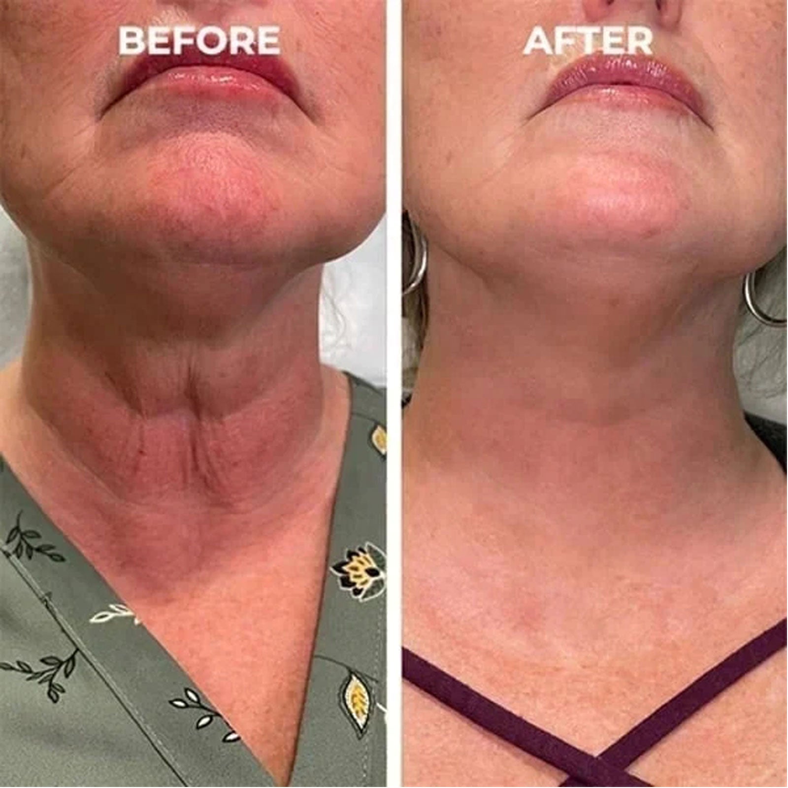 Facial Essence, Lifts And Tightens Facial Skin And Reduces Fine Lines And Wrinkles - Korvel