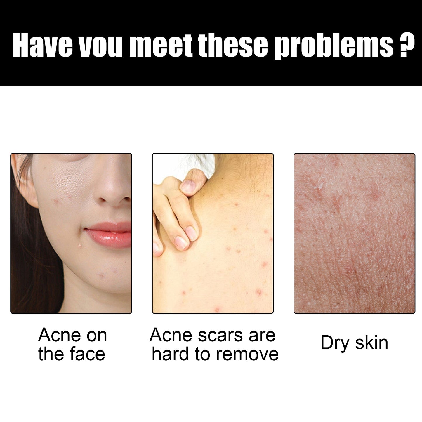 Shea Butter Black Soap, Repair Acne Pimple Acne Clear Pores Moisturize Smooth Skin Soap - Korvel