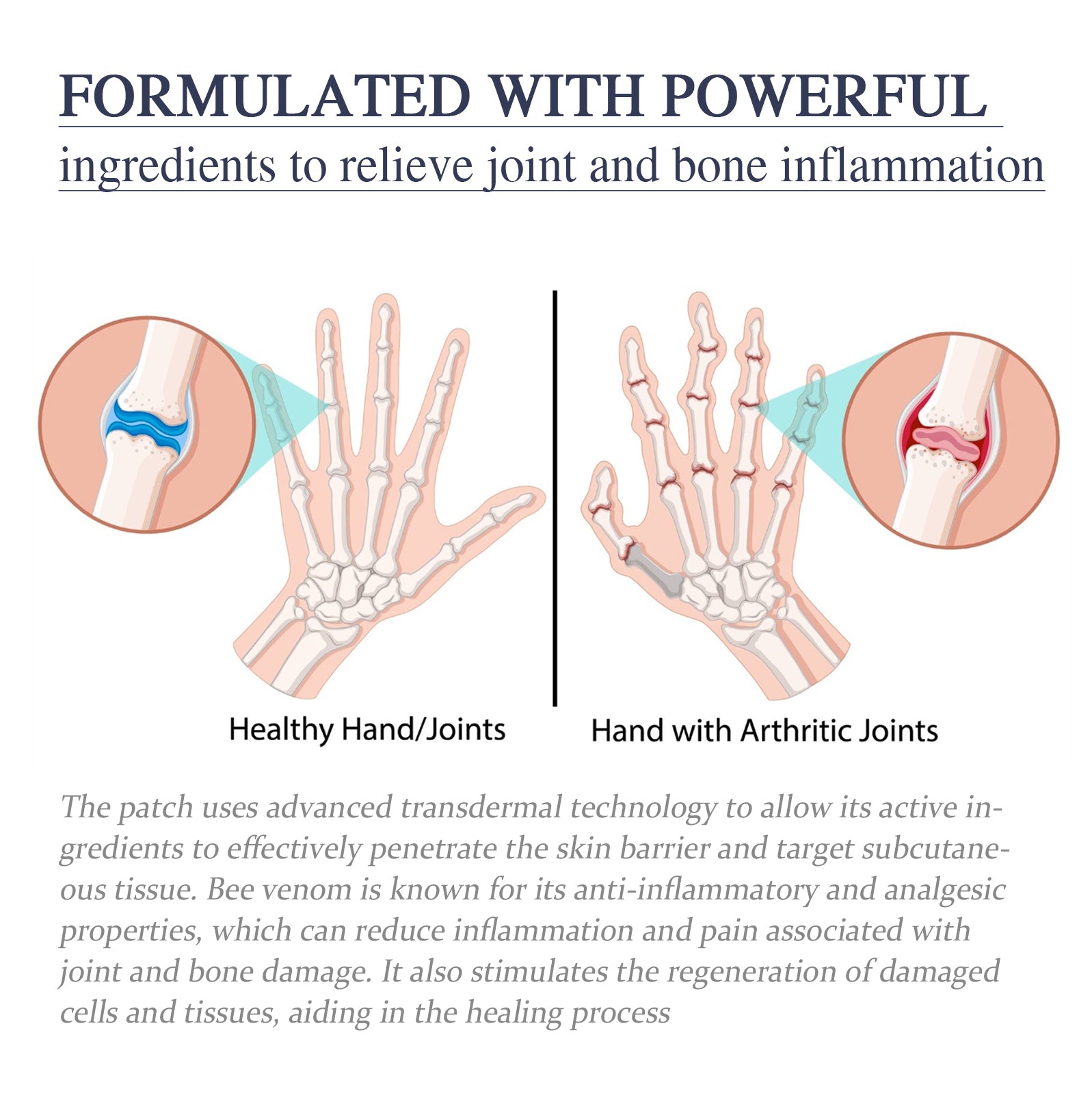Bee Venom Joint Cream, Relieves Hands Legs Bones Knees Lumbar Spine Sedentary Joint Pain Body Care Cream - Korvel